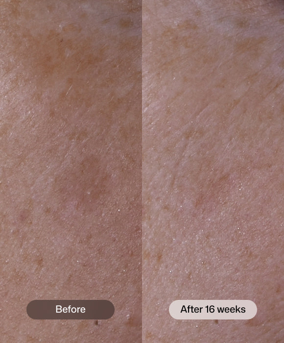 Before and After photo of a close up of skin